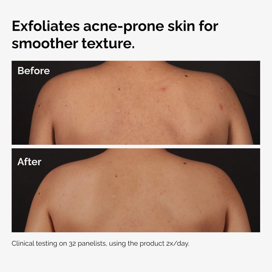 salicylic-acid-0-5-body-serum-y8 ord-salicylic-acid-body-serum-before-after-graphic-NA.jpg